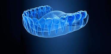 Dental Implants Image